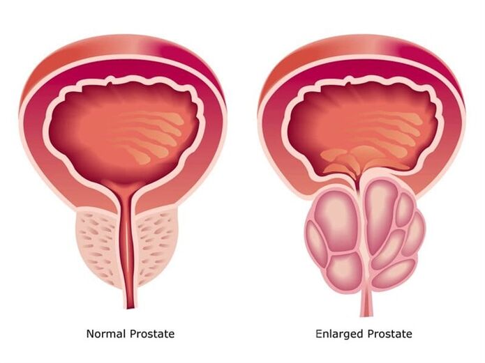 Prostovit-ek prostatako lana eta tamaina normalizatzen ditu