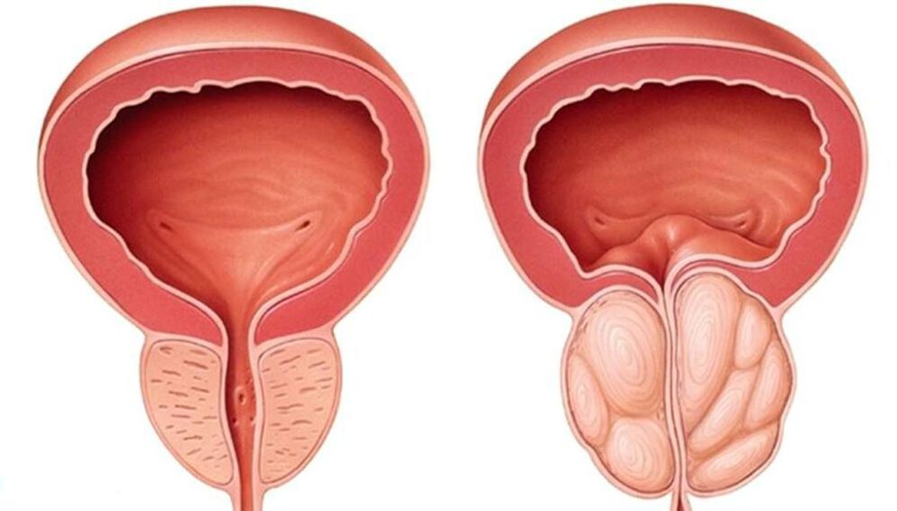 prostata normala eta handitua