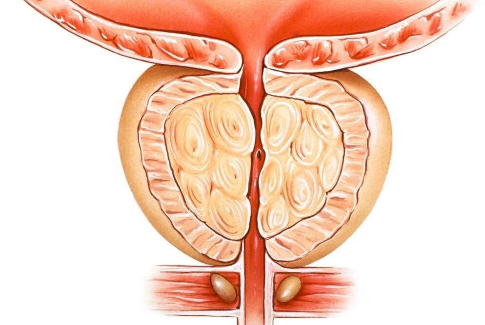 prostatitis kongestiboa