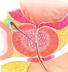 Prostatako adenoma