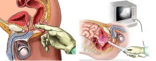Prostatitisaren diagnostiko instrumentala