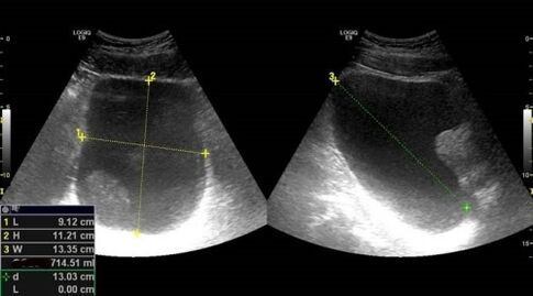 Prostatitisaren seinaleak ultrasoinuetarako
